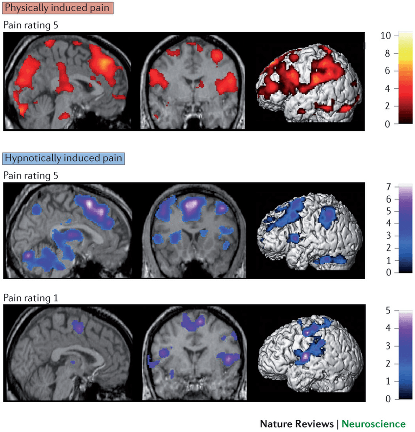 MRI images of hypnotic pain and physical pain